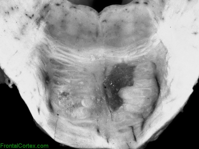 Lacunar infarcts, pontine base, transverse section